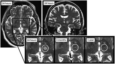 Longitudinal MR imaging after unilateral MR-guided focused ultrasound thalamotomy: clinical and radiological correlation